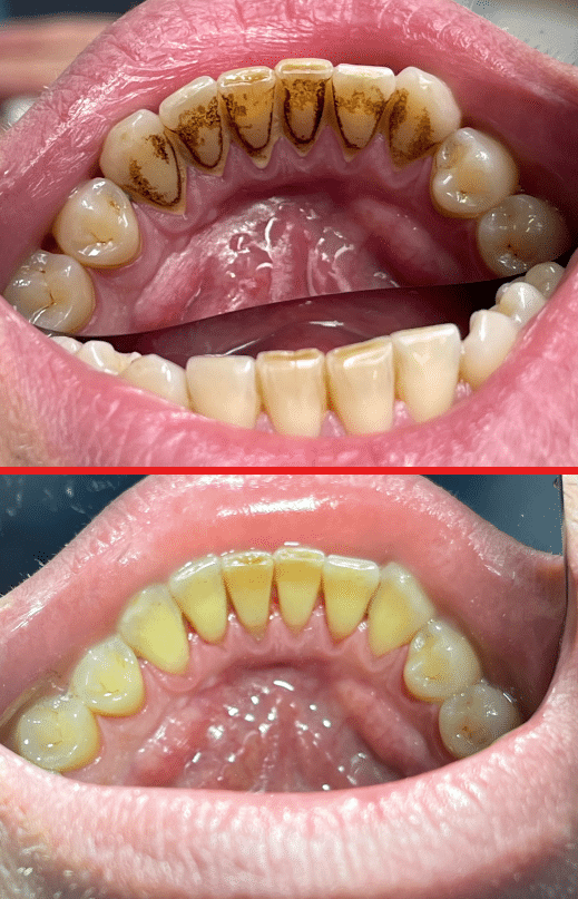 detartraj-3